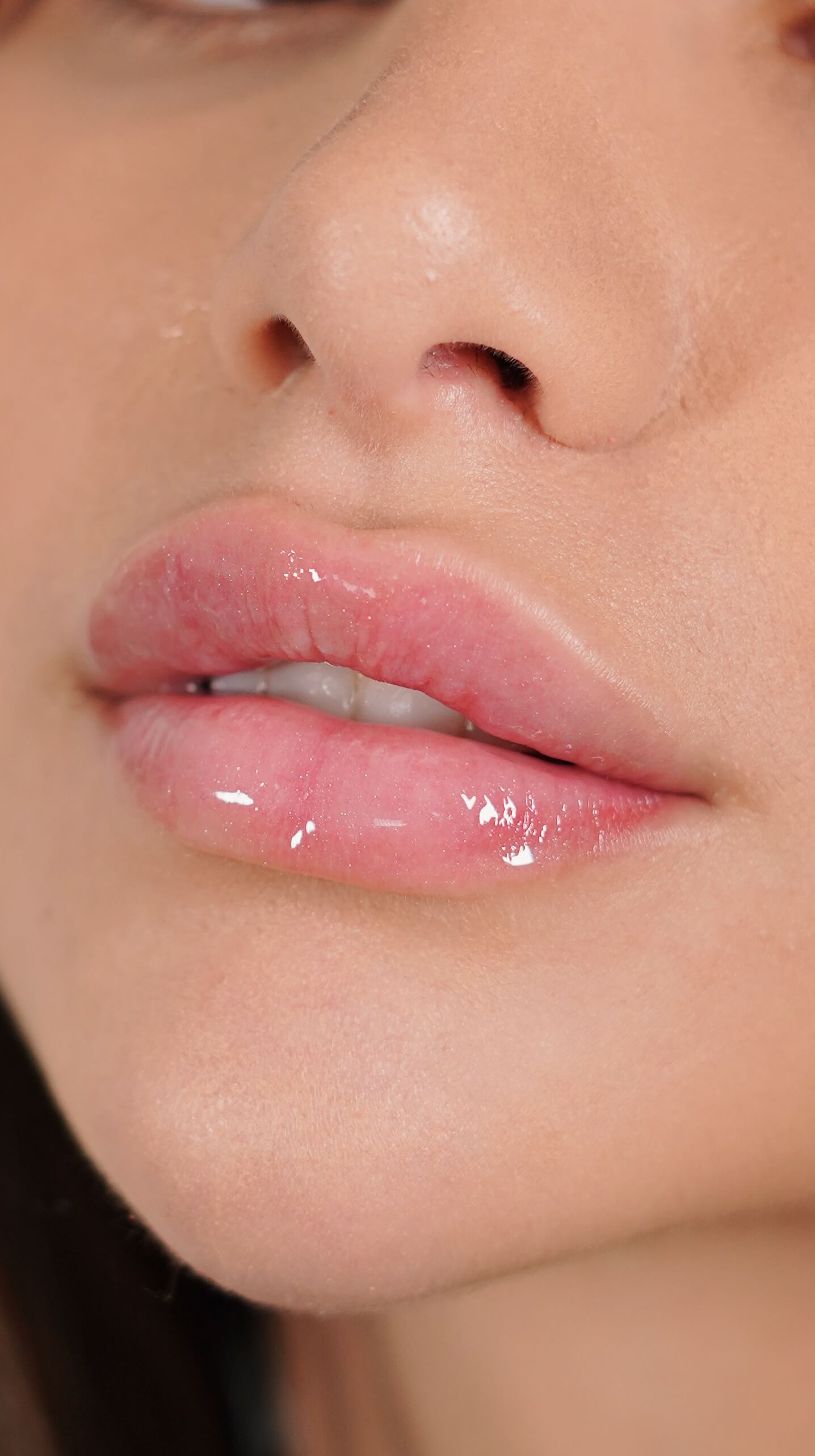 Hidratação Labial com Microagulhamento